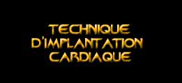 La technique d'implantation cardiaque